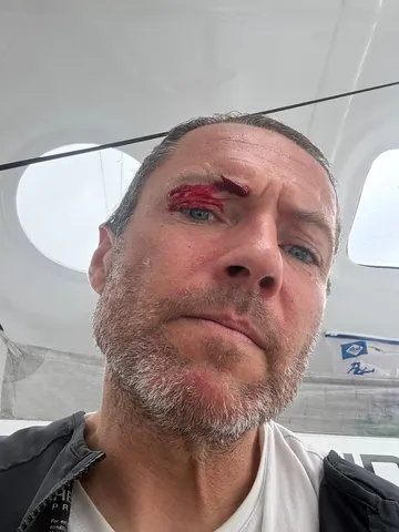 RACE, DECEMBER 02, 2024 : Photo sent from the boat Fortinet - Best Western during the Vendee Globe sailing race on December 02, 2024. (Photo by skipper Romain Attanasio)
Injury